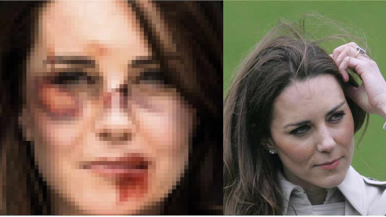 Kate Middleton, pestata pesantemente a sangue il viso è cosparso di